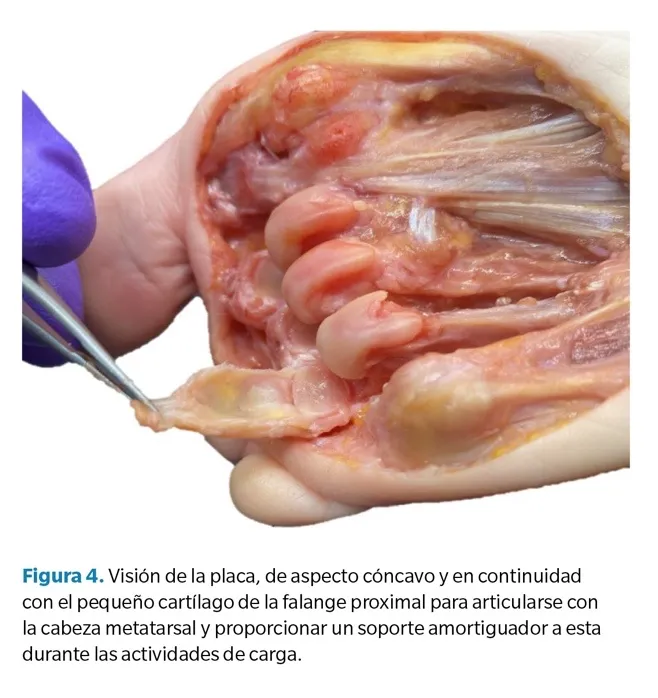 Disección anatómica de la placa plantar mostrando su estructura fibrocartilaginosa y relación con la articulación metatarsofalángica