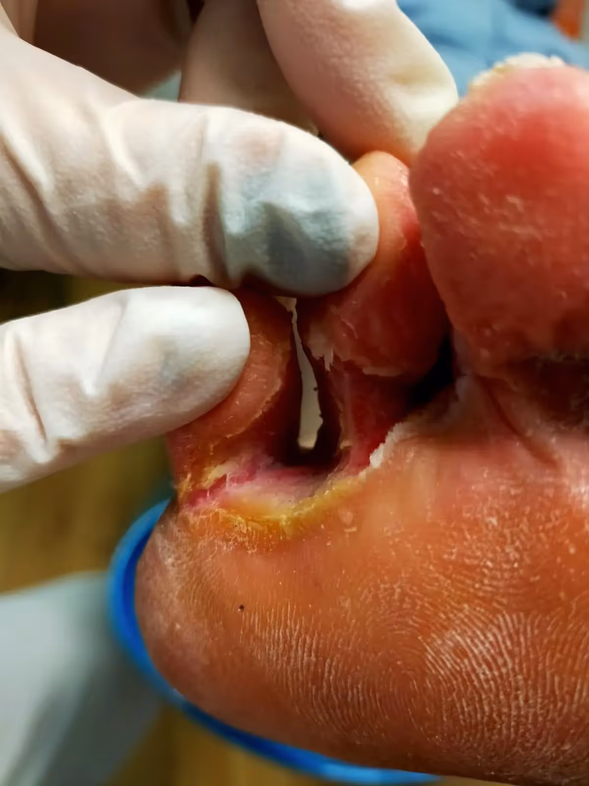 Planta del pie con signos de dermatomicosis: descamación, grietas y enrojecimiento entre los dedos