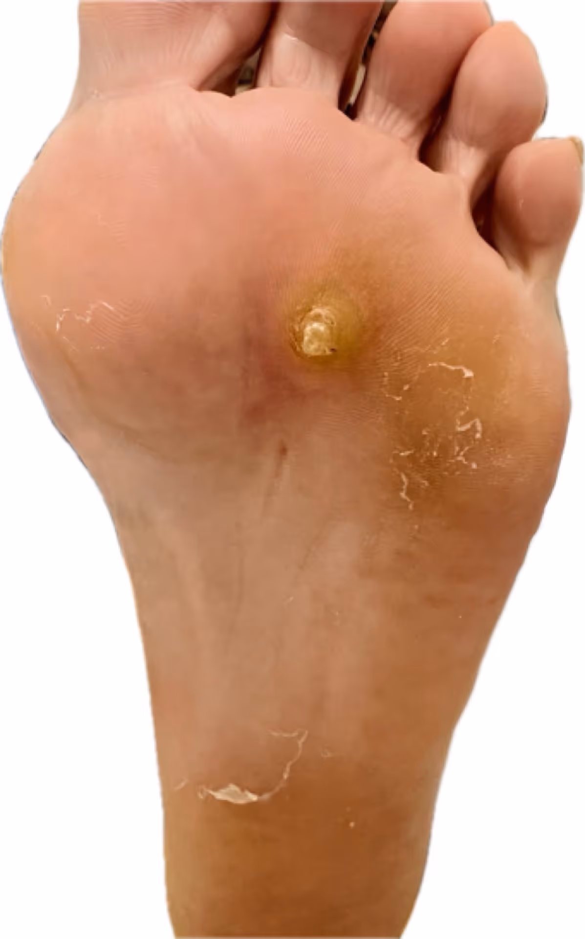 Queratosis plantar intratable en planta del pie antes del tratamiento con láser podológico