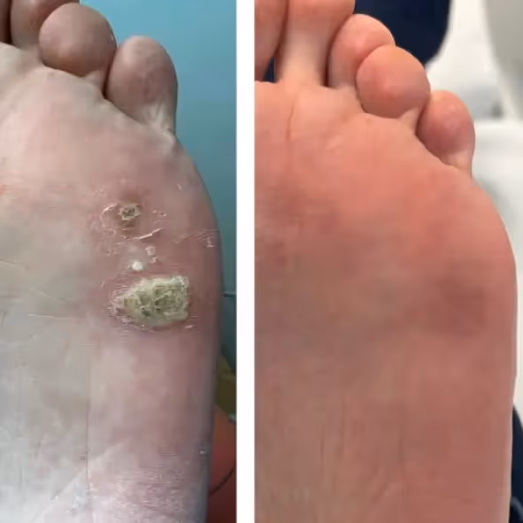 Caso clínico de cirugía láser podológica en Centro Podológico Henao