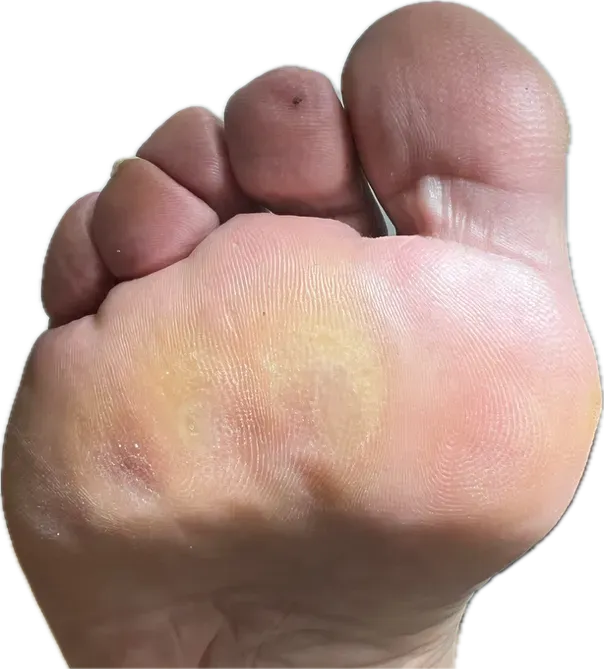 Paciente diabético en consulta podológica por metatarsalgia bilateral en Bilbao