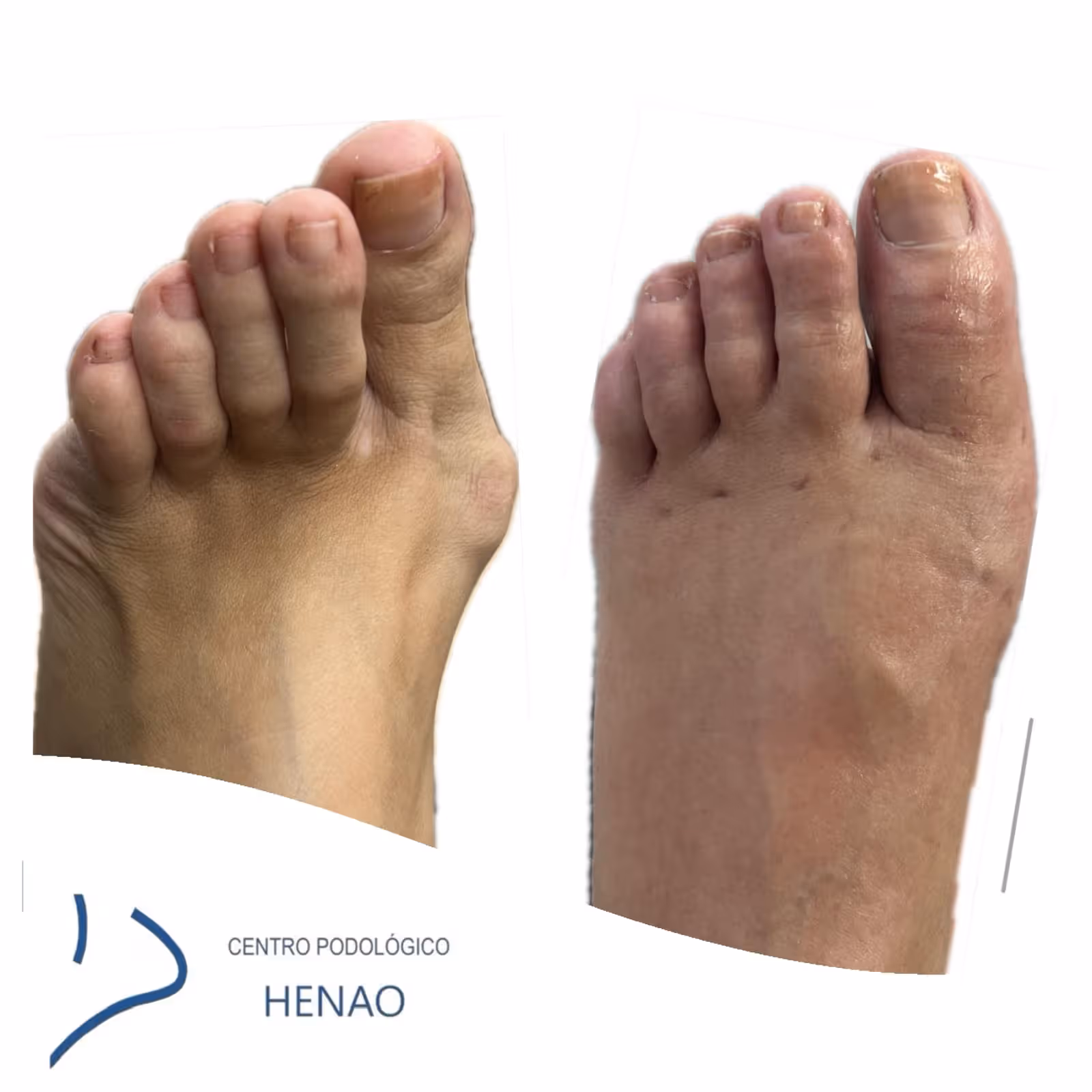 Cirugía mínimamente invasiva para juanetes en Bilbao