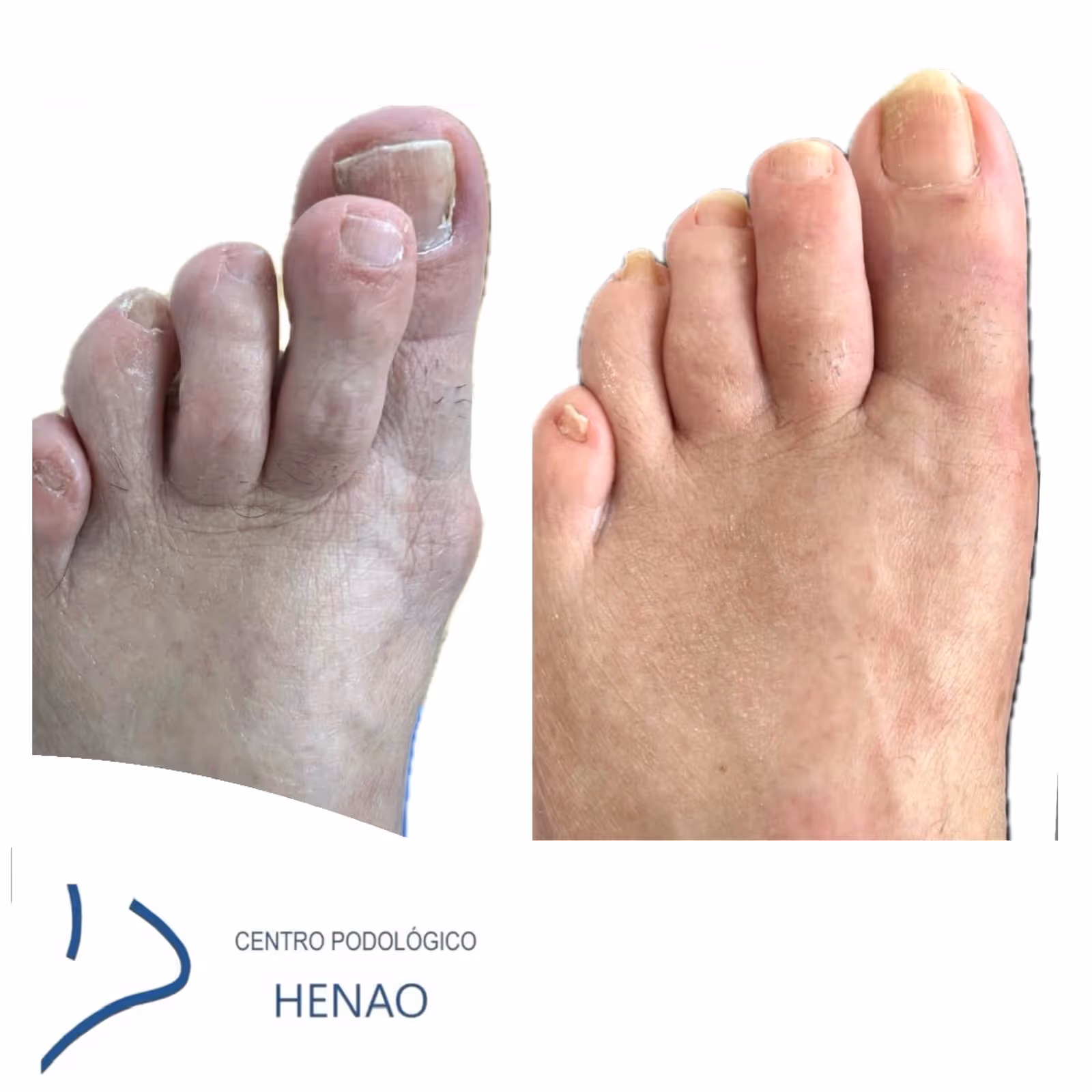 Recuperación tras cirugía mínimamente invasiva de juanetes en CPH