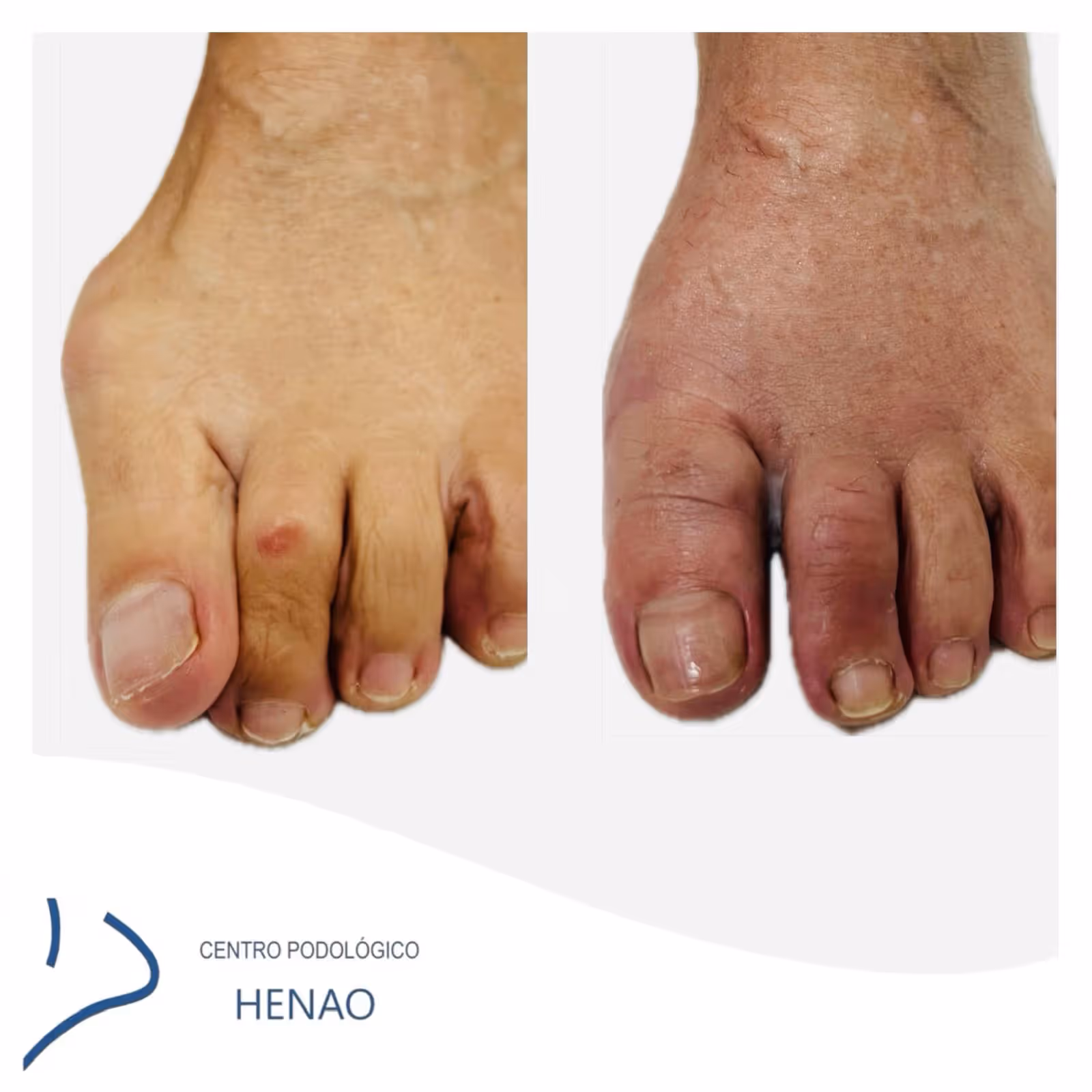 Corrección de hallux valgus mediante cirugía MIS en Centro Podológico Henao