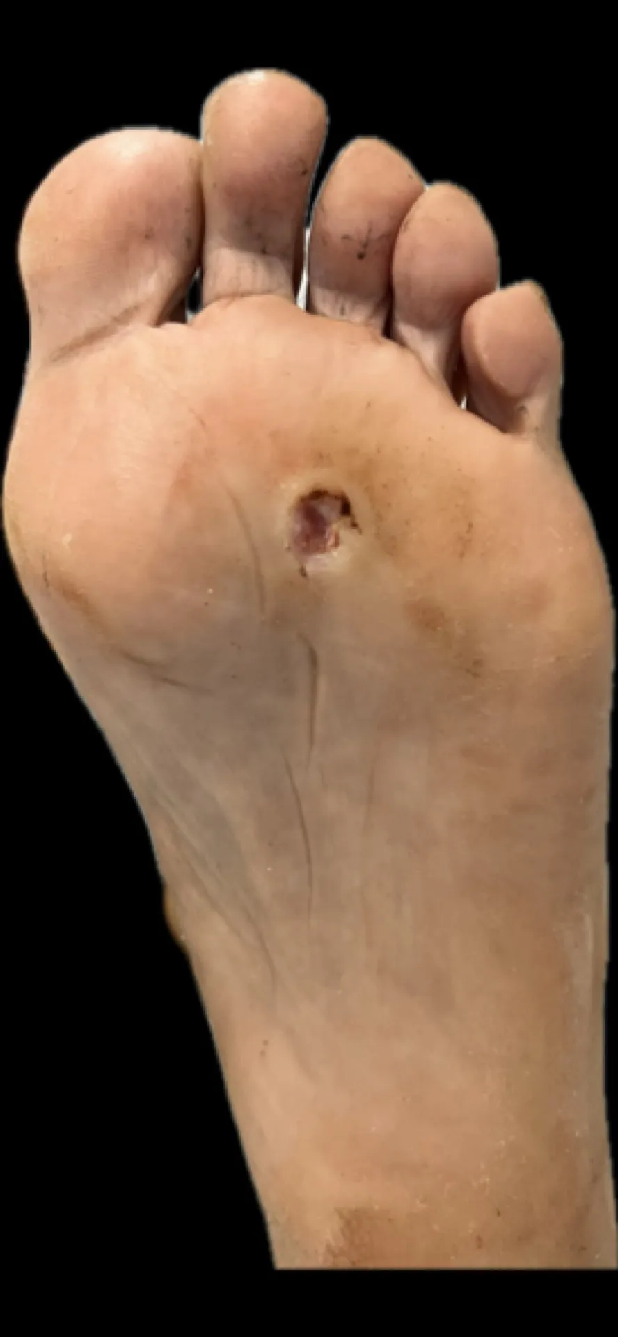 Detalle de la lesión plantar