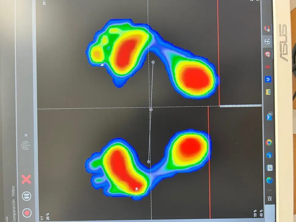 Ecografía musculoesquelética mostrando atrofia del panículo adiposo plantar