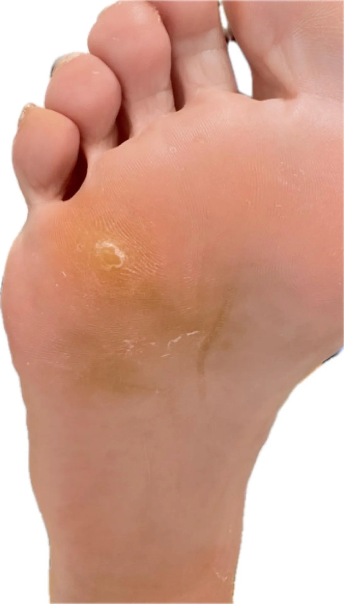 Estudio ecográfico de la lesión