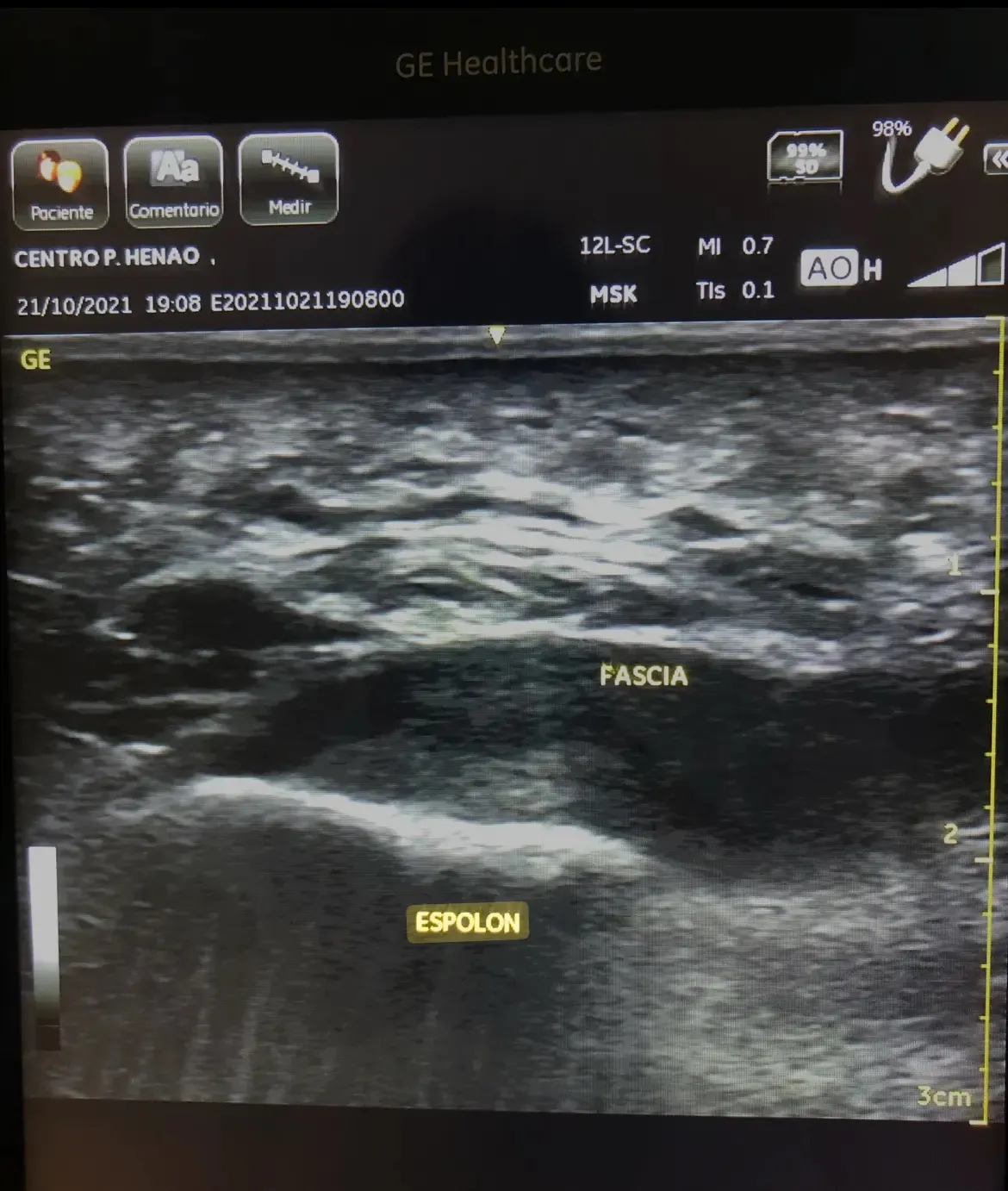 Radiografía lateral de pie mostrando espolón calcáneo comparada con ecografía de fascia plantar