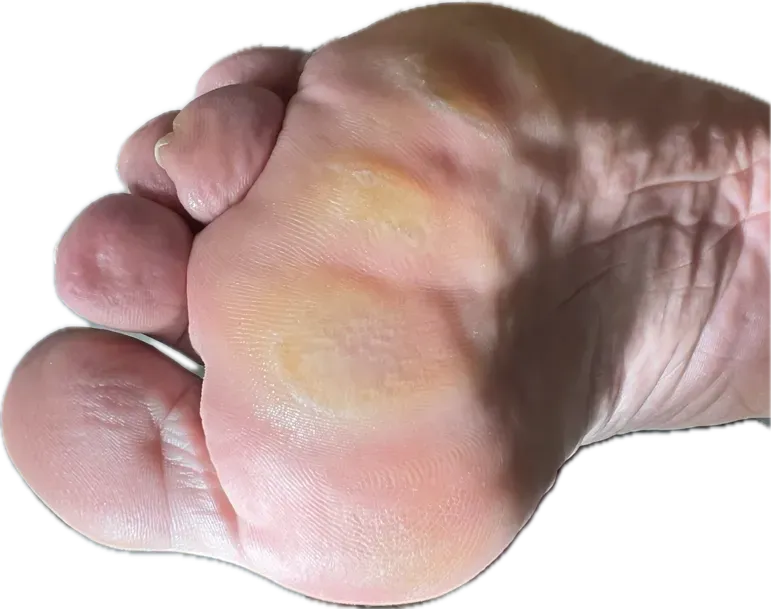 Hiperqueratosis plantar marcada en antepié de paciente diabético