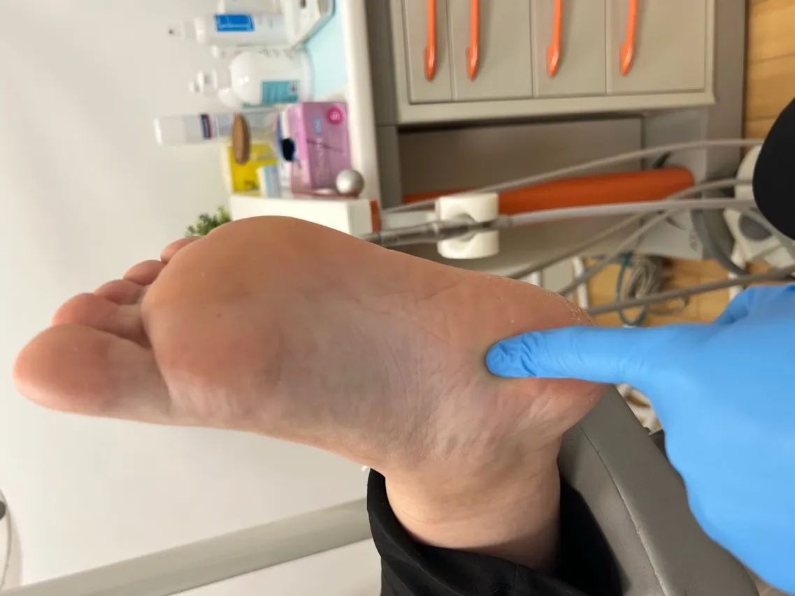 Exploración clínica del talón en paciente con fasciopatía plantar crónica en Centro Podológico Henao Bilbao