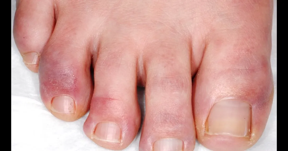 Sabañones en los pies: guía completa de síntomas y tratamiento