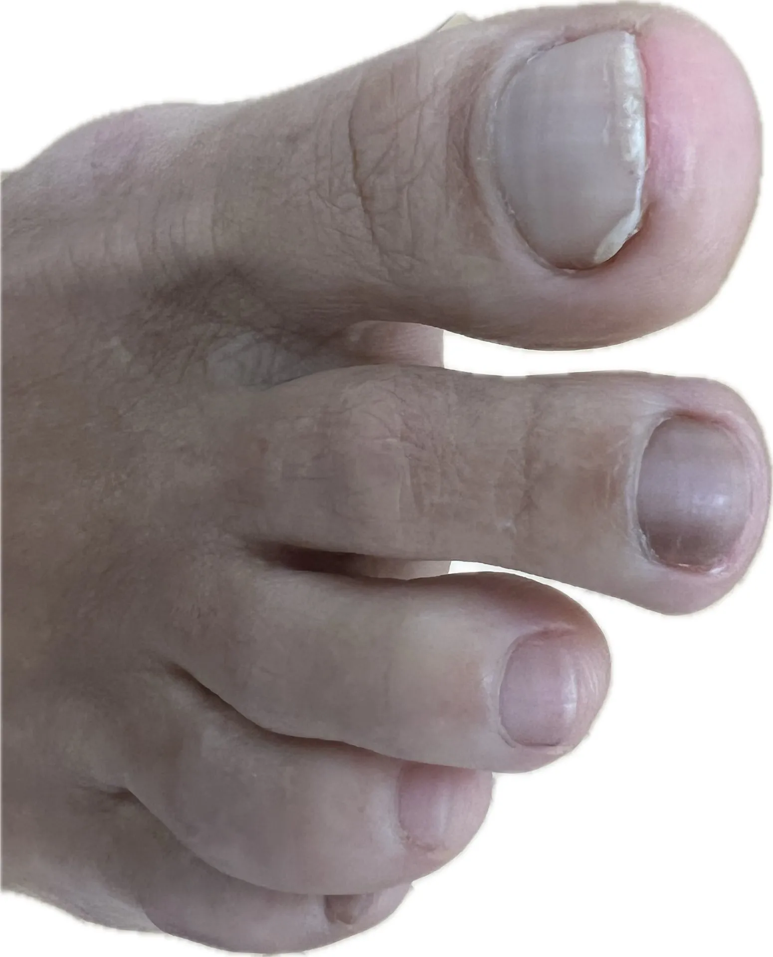 Melanoniquia caso clínico uñas negras diagnóstico Centro Podológico Henao Bilbao