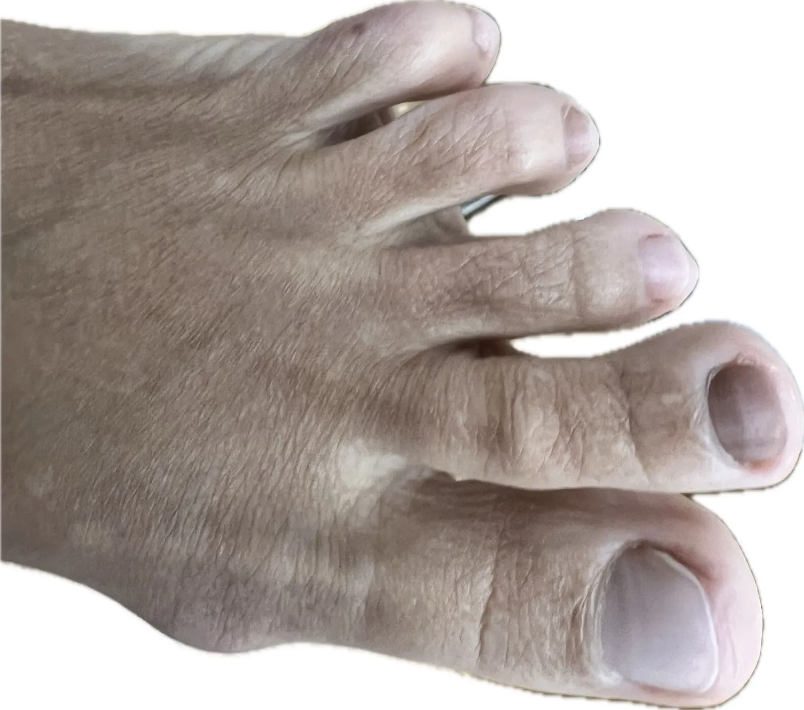 Evaluación clínica melanoniquia uñas negras podólogo Centro Podológico Henao