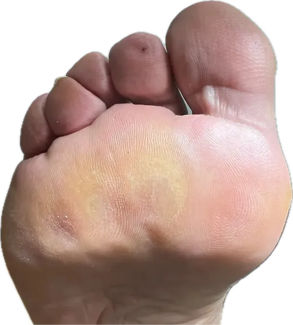 Diabetes y Dolor de Pies