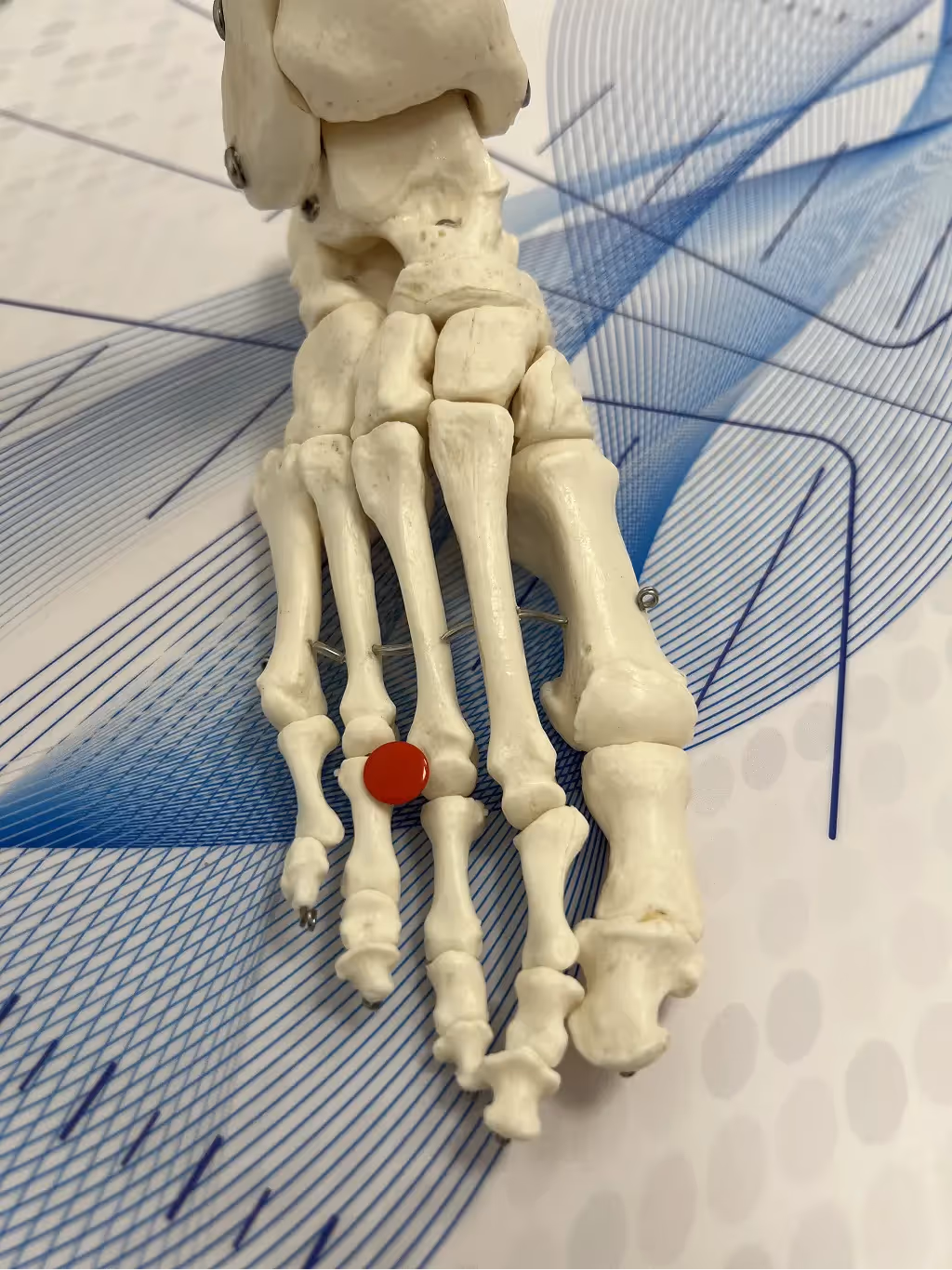 Caso clínico de neuroma de Morton en podología Bilbao