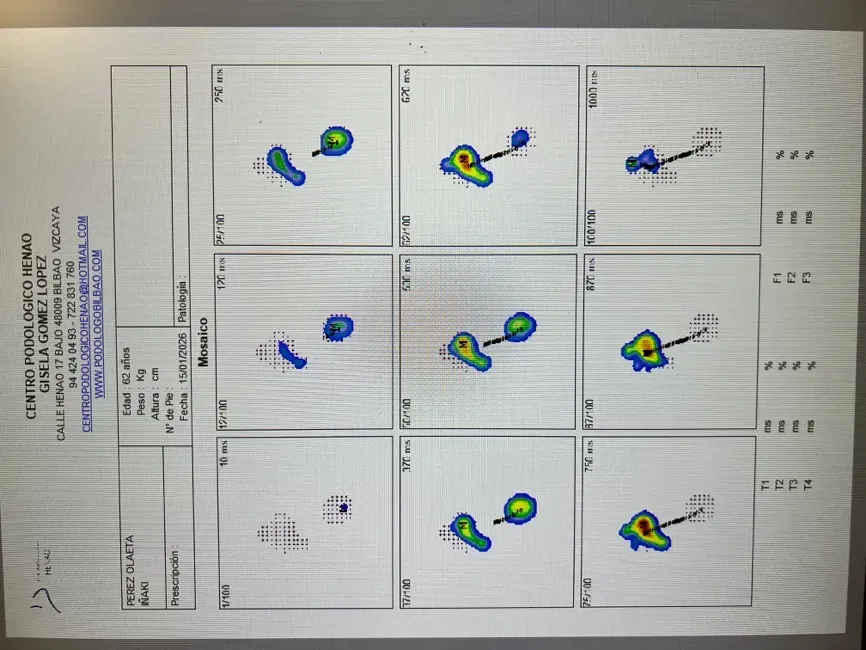 Estudio de presiones plantares con picos elevados en metatarsianos