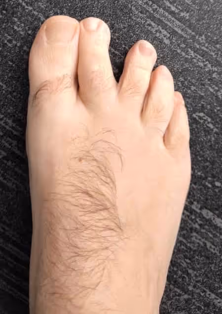 Separación entre segundo y tercer dedo del pie tras traumatismo directo en antepié caso clínico Centro Podológico Henao Bilbao