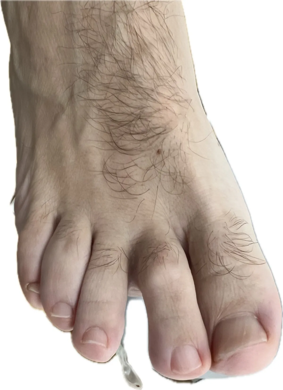 Detalle separación anómala entre dedos del pie por lesión placa plantar y ligamento colateral tras traumatismo