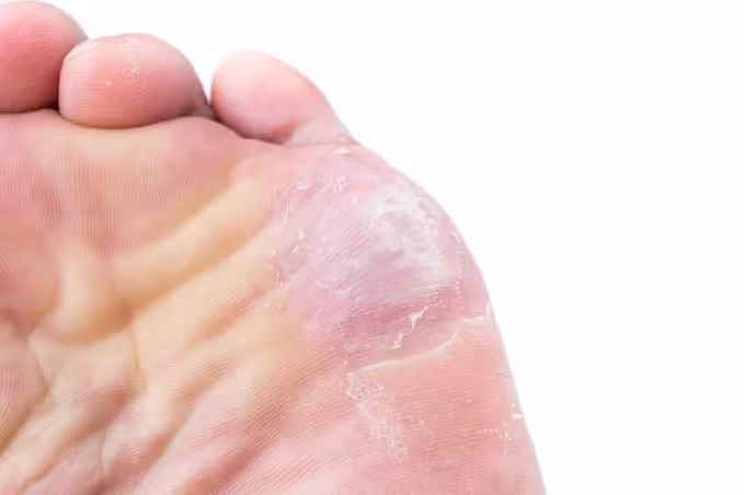 Tratamiento de hongos en los pies con terapia láser en consulta podológica