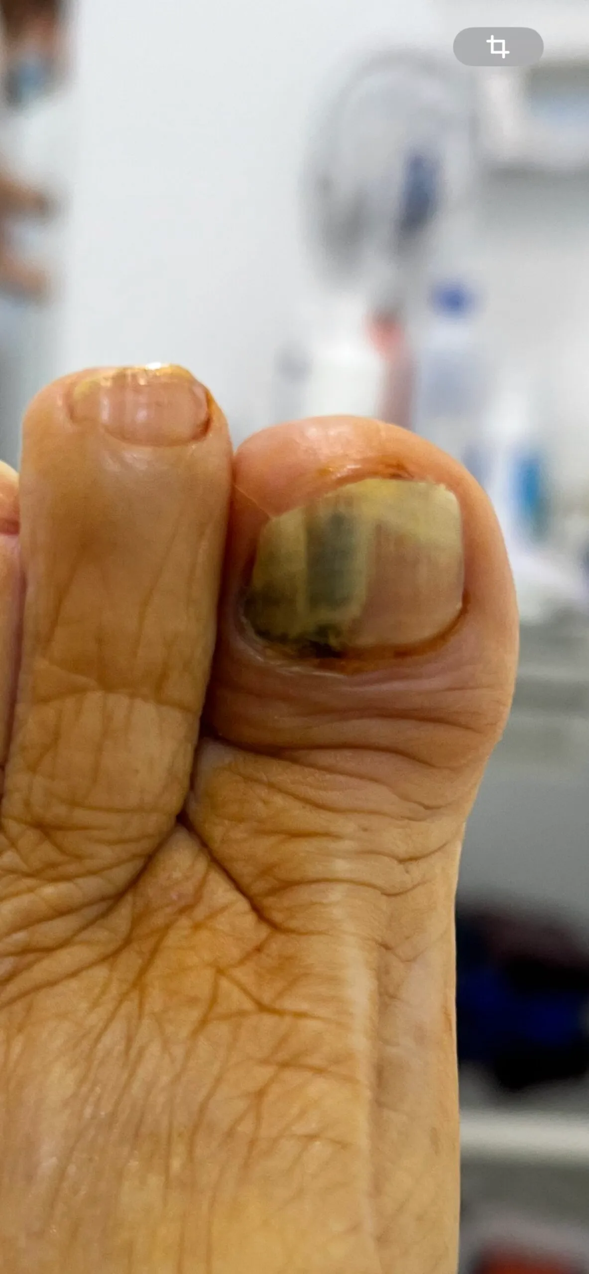 Uña con banda longitudinal pigmentada característica de melanoniquia