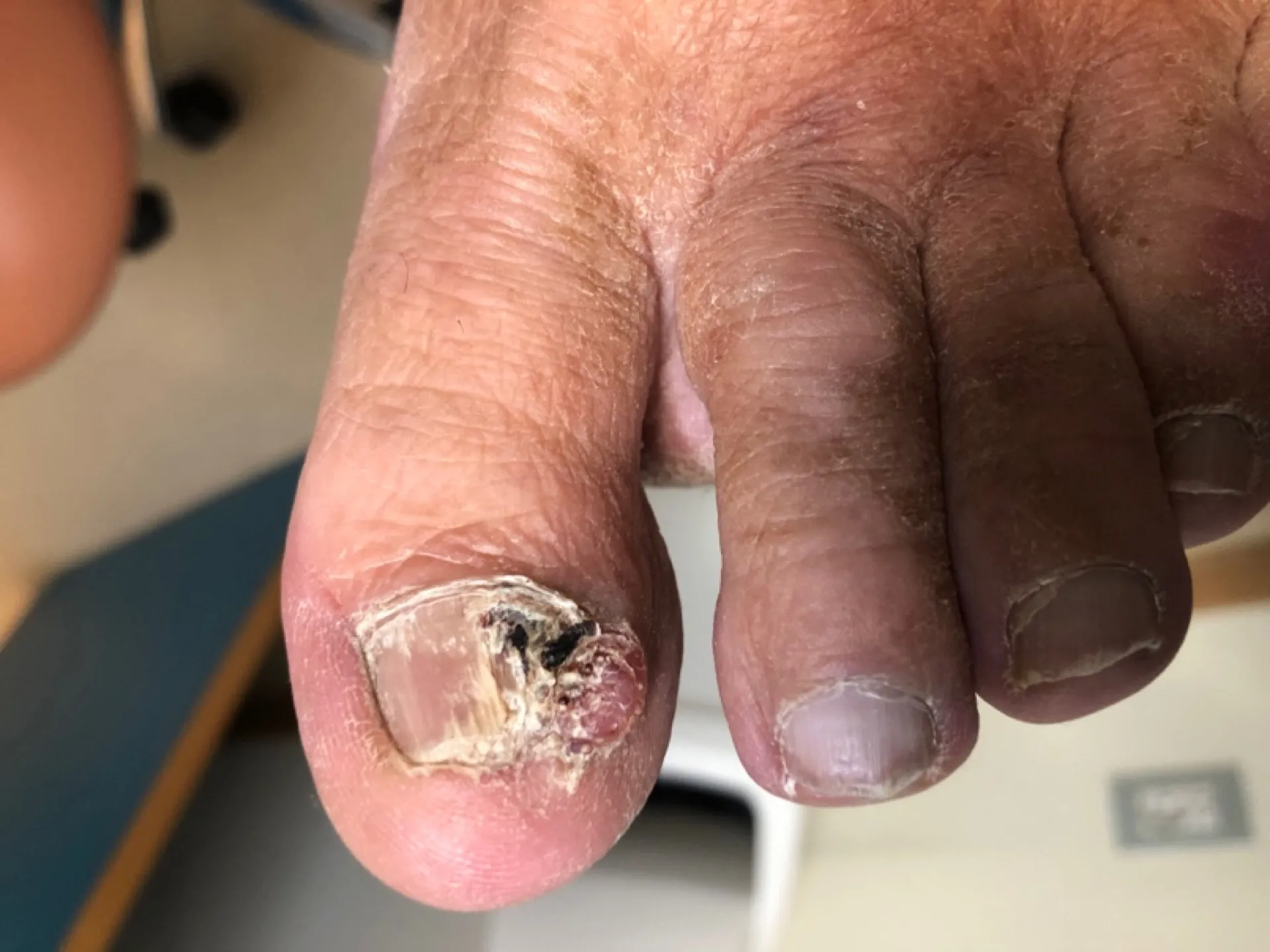 Uña con pigmentación irregular y bordes mal definidos - signos de alarma melanoma