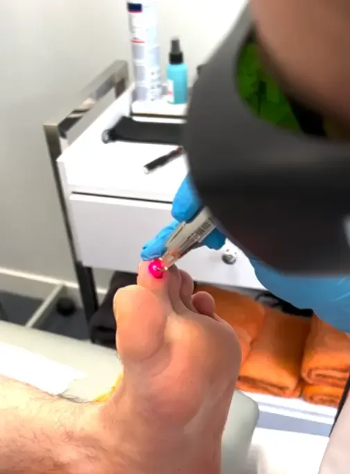 Tengo Verrugas Plantares