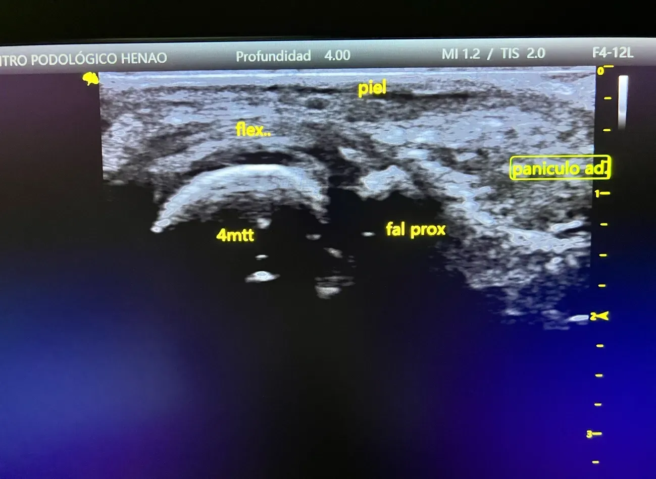 Soportes plantares a medida para redistribuir presiones en pie diabético