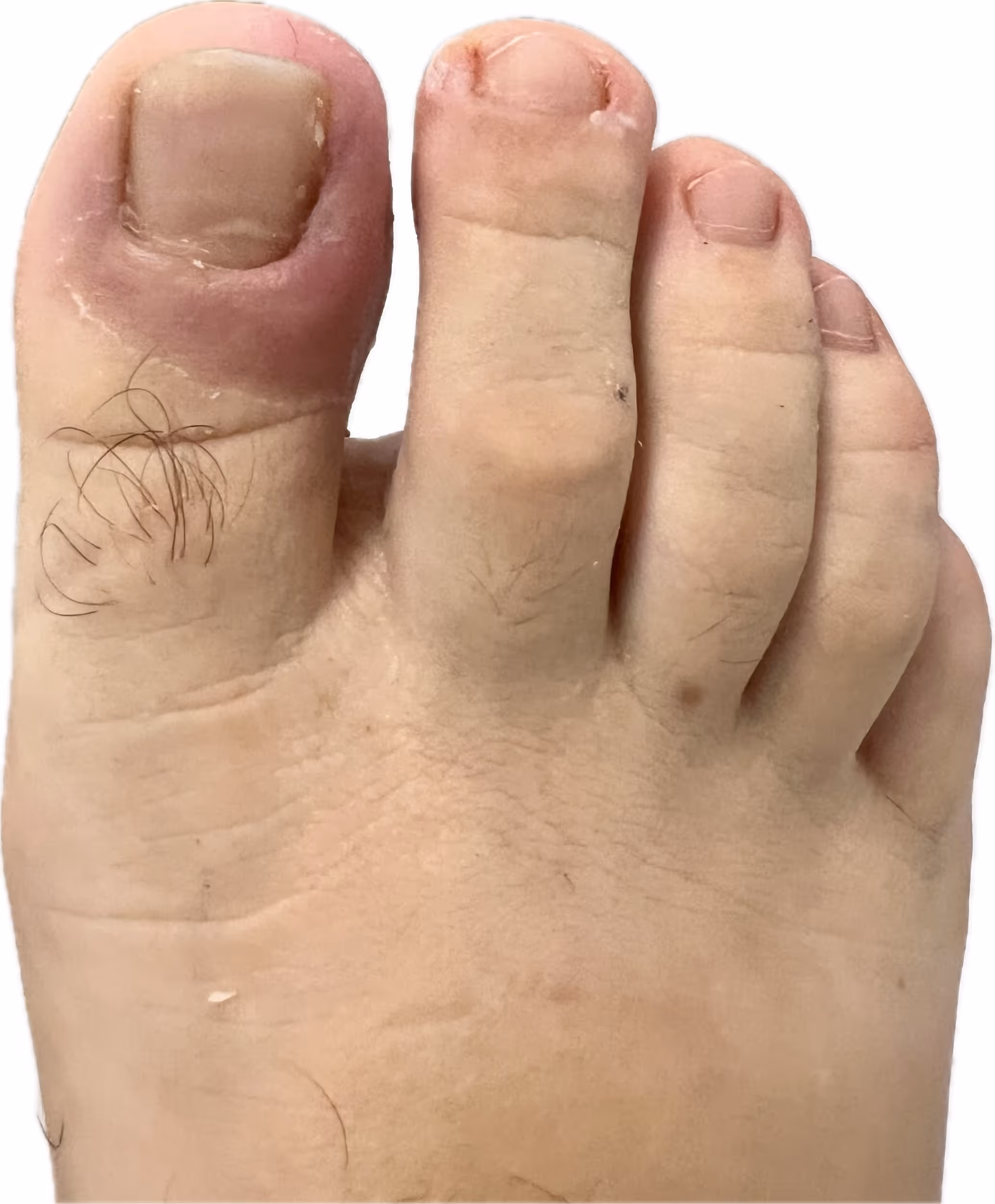 Resultado después de cirugía láser de uña encarnada - Centro Podológico Henao