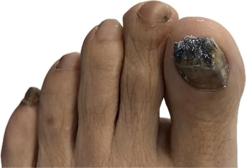 Uña negra voluminosa por exostosis subungueal antes de cirugía en Centro Podológico Henao Bilbao